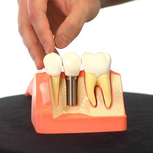 Приживление зубных имплантатов