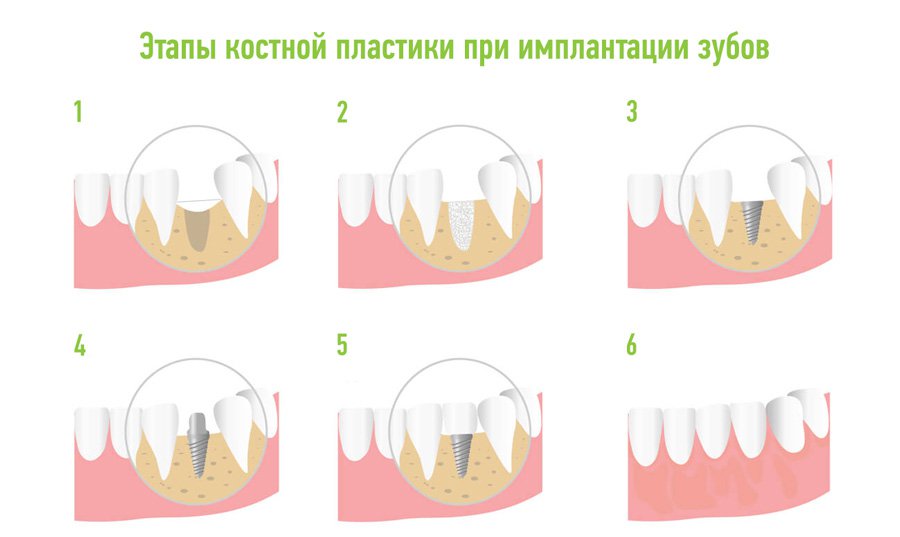 костная пластика и имплантация зубов