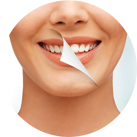 Как и с помощью чего происходит наращивание зуба?