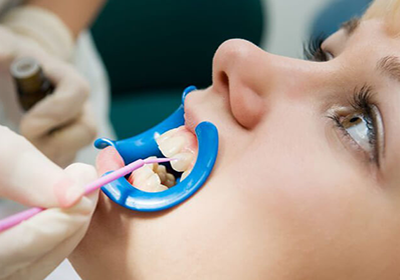 Фторирование зубов – надежная защита от кариеса