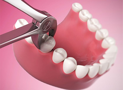 Как выполняется удаление зуба?