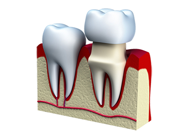Зубное протезирование на основе металлокерамики