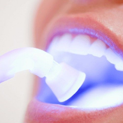Отбеливание зубов 