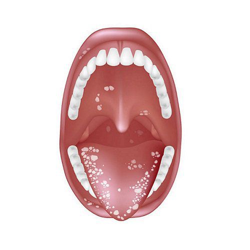 Дисбактериоз полости рта 