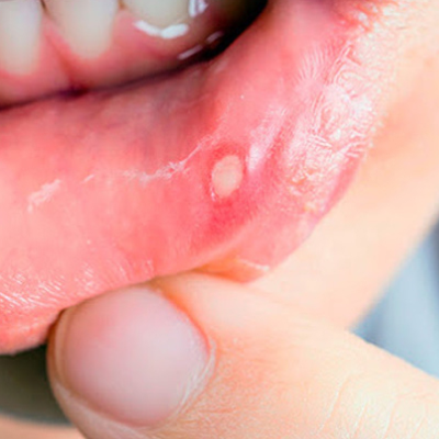 Воспаление слизистой оболочки рта у детей