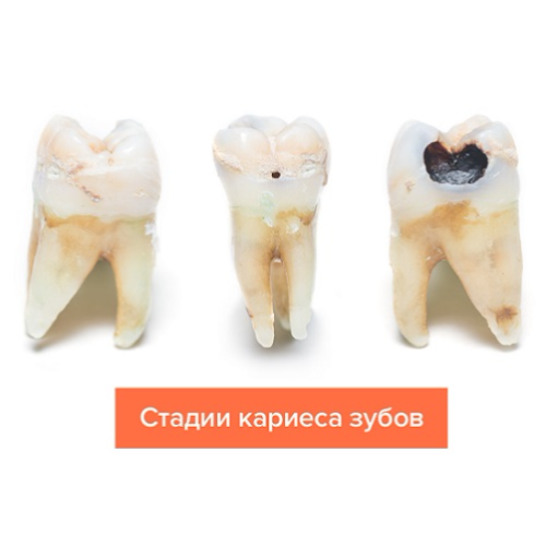 Кариес зубов 