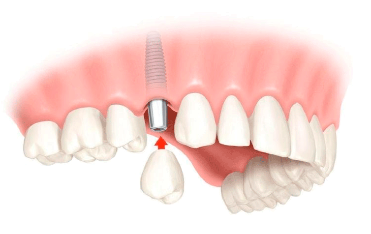 Ustanovka-implanta-zuba-61.png