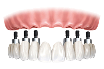 Как проводится протезирование при отсутствии большого количества зубов?