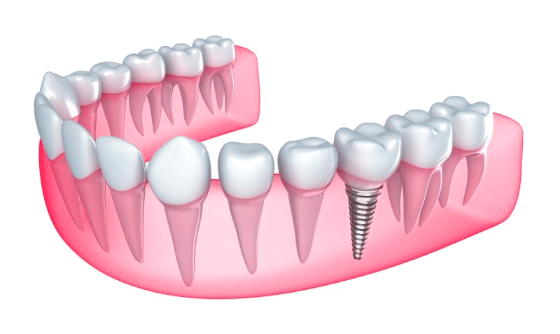 Implantatsiya-zubov-94.png